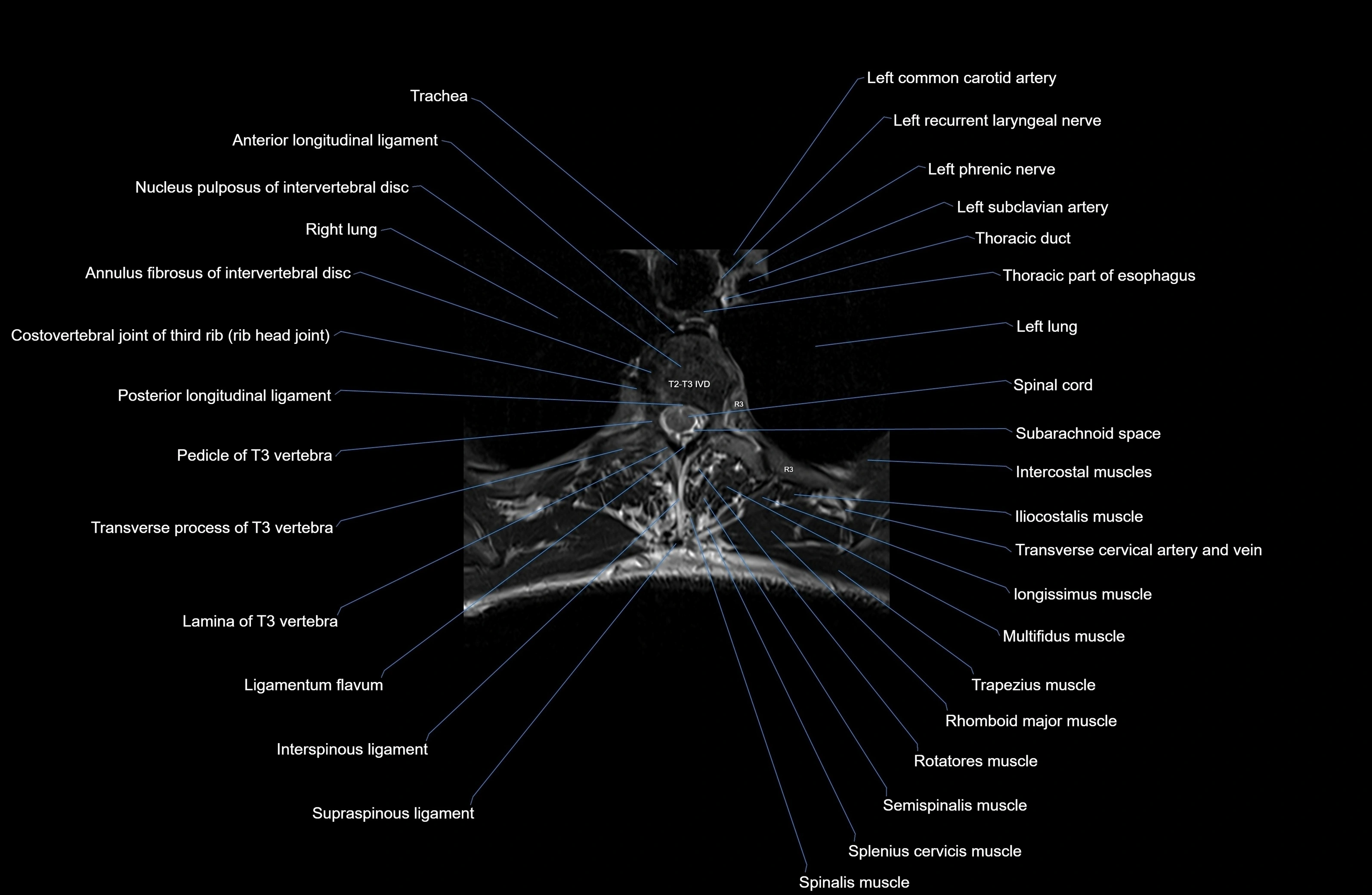 MRI thoracic spine axial  cross sectional anatomy 3T radiology  image-img-00001-00018.webp